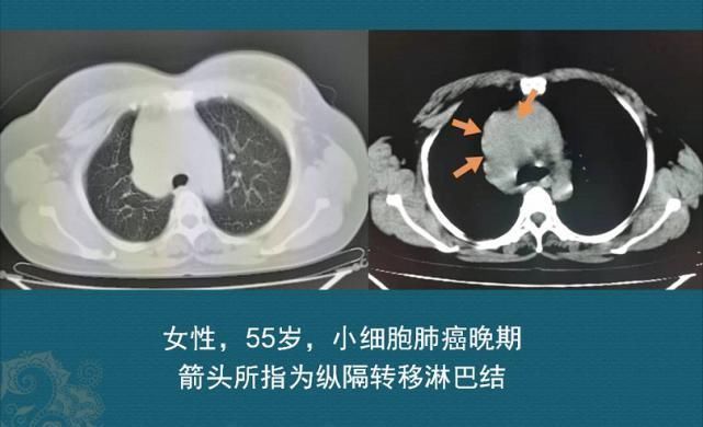 肝转移瘤|查出癌症不放疗不化疗，保持良好心态吃喝玩乐，能扛过去吗