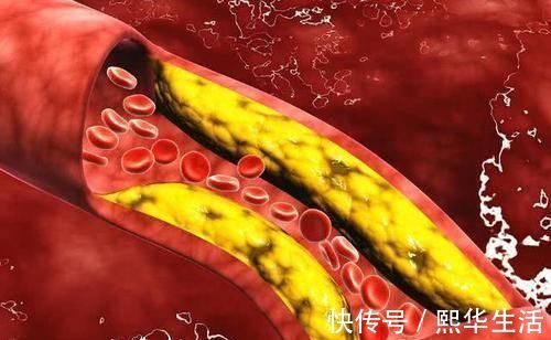 橄欖油|甘油三酯降不降看日常生活三點做絕不絕，血脂正常不是問題