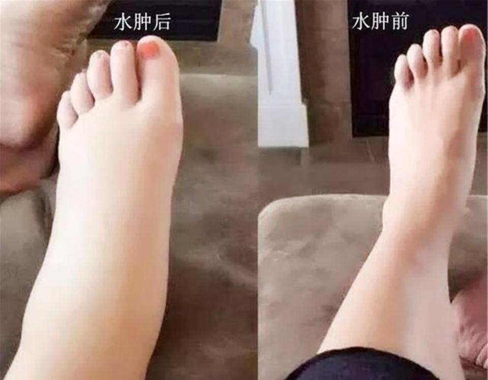 准妈妈|担心孕期水肿影响胎儿，23岁新手妈妈少喝水，医生说她自作聪明