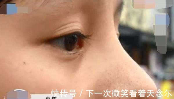 隆鼻|女子隆鼻手术成功, 却遭到嘲笑 你的五官配不上这么完美的鼻子
