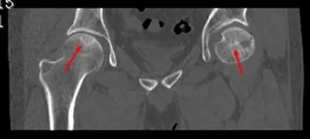 杭州|杭州65岁大伯股骨头坏死，只因他有这个习惯！这几类人是高发人群