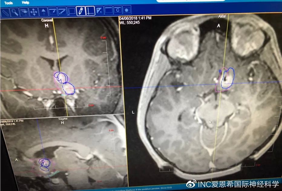 srs|LITT技术：不开颅，也能治疗小儿脑瘤及癫痫