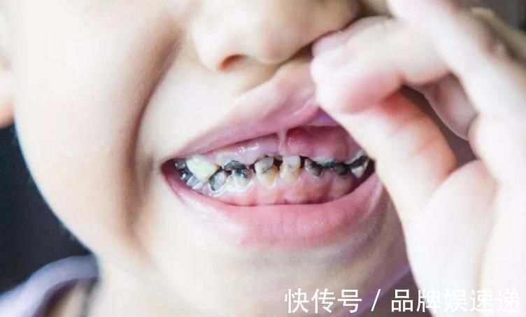恒牙|牙科医生提醒,孩子正在换牙的父母们,你们一直都做错了什么?