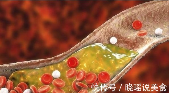 总胆固醇|血脂高,“头”先知若出现这4“异常”,或是“高血脂”入侵