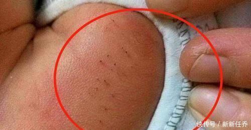 妈妈发现宝宝的背上长满了''黑刺''，把刺一根根拔掉，医生检查后大骂无知