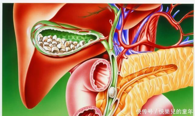 油腻食物|胆石病怎么办?5种中成药化瘀散结,利胆排石,改善疼痛