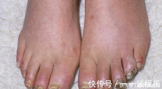 肾脏|接连感冒被查出尿毒症,肾病早期会有4个“求救”信号,不妨一看