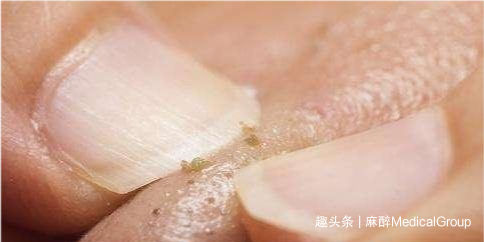 鼻子上总出黑头，可以随便挤它么？