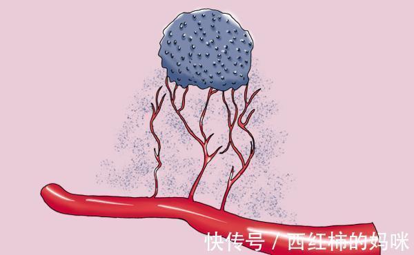 肿块|癌症患者，癌细胞扩散后，放屁次数会增多？癌症扩散，有啥感觉？