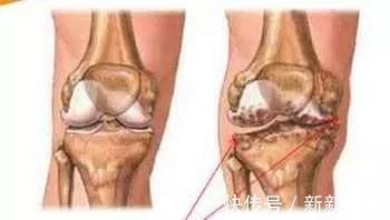 褚实子|骨质增生必看!一个非常强大快要失传的方子,2味药治好5年足跟痛