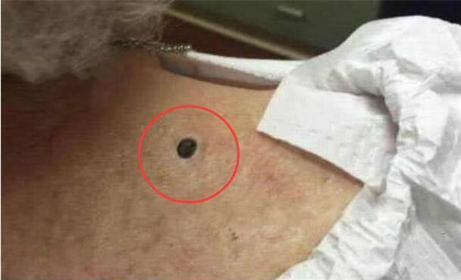 儿子|宝宝后背长颗“黑痣”,一碰就痛,医生取出的东西妈妈无法淡定