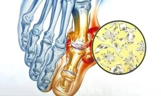 医生|痛风大多是“拖”出来的，医生：出现“2多2疼”，赶紧调理