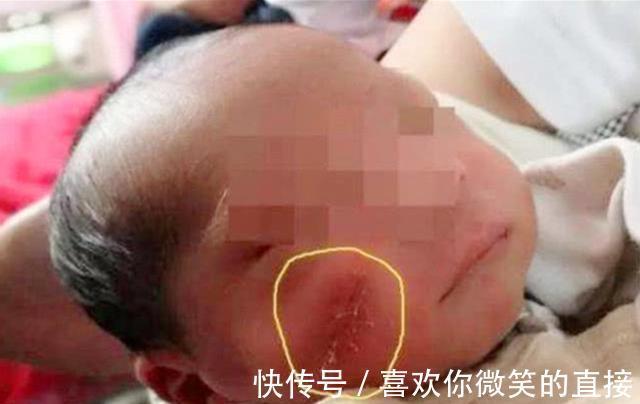 亲人们|5年前因吃奶太用力,被妈妈刮成“花脸猫”的宝宝,如今怎么样了