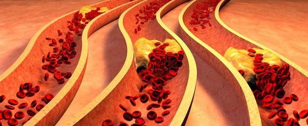 脑梗|从高血脂到脑梗其实就3步,做好3件事,血脂降正常,远离脑梗