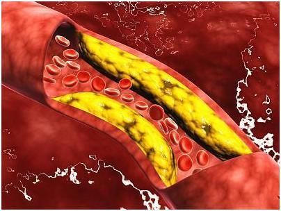 血管的清洁工不是山楂而是它,若坚持吃,高血脂退避三舍