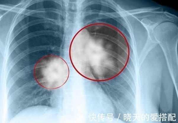 肚回弹|46岁男子,不痛不痒,查出肺癌,手上1个异常,提示已到中晚期!