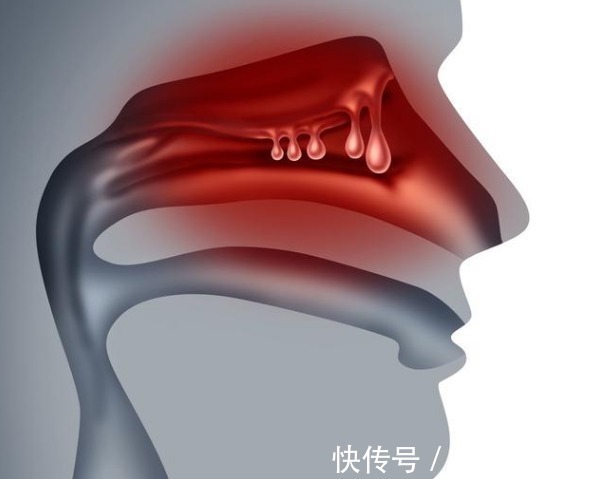 慢性鼻炎|鼻炎的祸根终于找到!常喝1杯水,赶走鼻塞流涕,呼吸畅快
