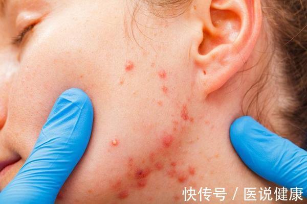 丘疹|当毛囊炎到来时,身体会出现4个表现,留意到一个,也要重视