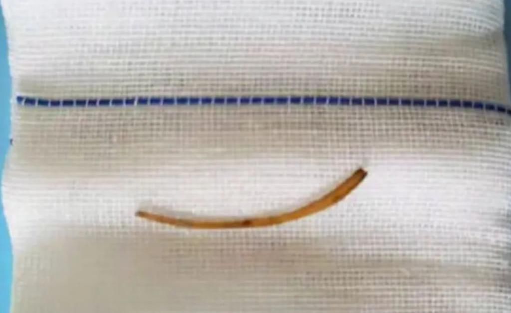 直肠腔|男子长“痔疮”疼痛难忍,万万没想到是它卡在肛门!