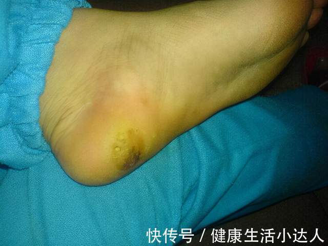 金兰菊根茶|血脂多高才算是高？身体出现5个信号，要开始降脂养血管了