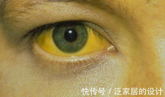 症状|提醒：5个身体症状，说明肝病在“恶化”，为健康别轻视