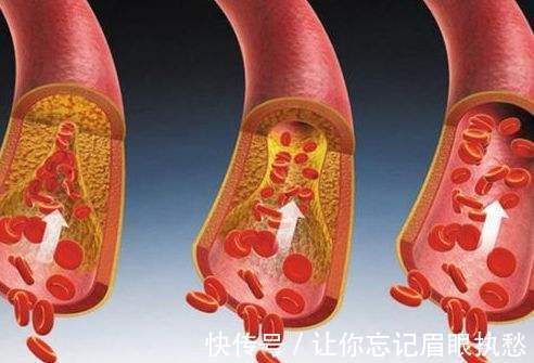 莓茶|“天然阿司匹林”终于找到了！用这些叶子泡水喝，血栓被哗哗冲走