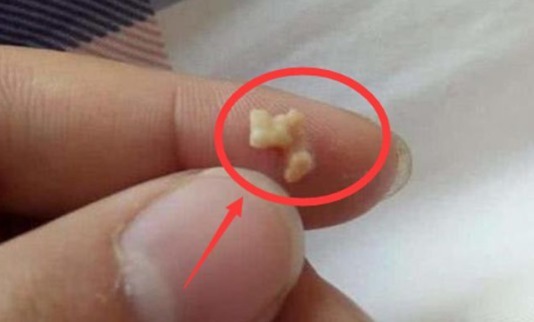 信号|嘴里的“米粒”，是身体发出的“求救信号”，大部分人嘴里都有