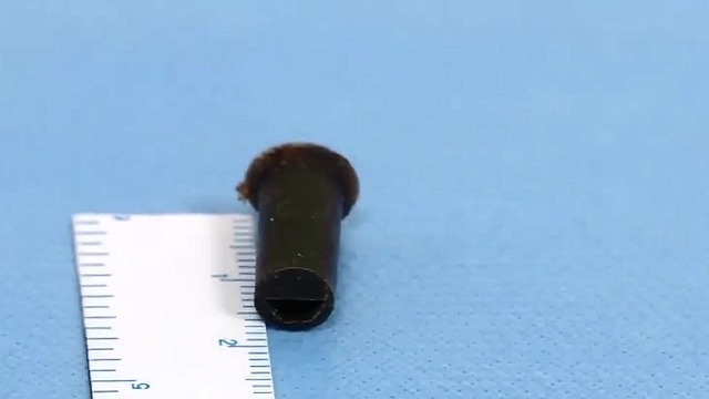 海姆立克法|男子6岁时吞了个……怕被家长骂,竟瞒了20年