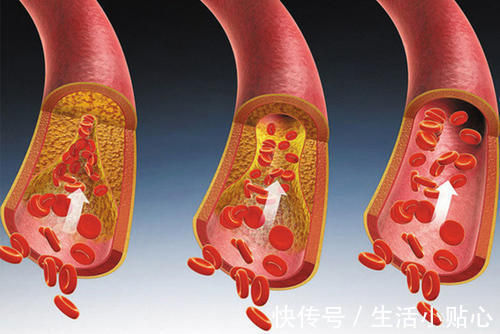 心脏病|脱脂奶是否更有益于心脏病、高血压、高血脂病人?不妨了解下