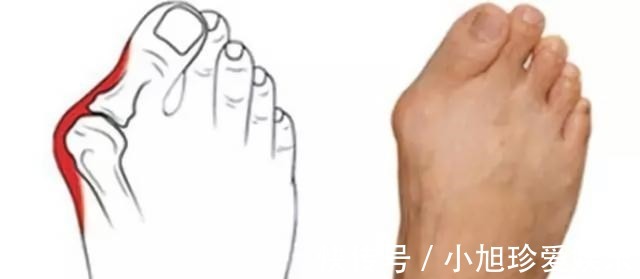 拇囊炎|穿高跟鞋的危害到底有多大?