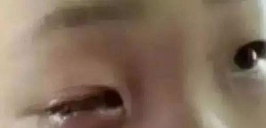 疏忽大意|20分钟孩子眼球被溶化!医生说这东西每家都有,家长要高度警惕