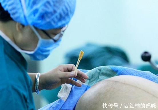 后遗症|做剖腹产打麻醉，以后会对腰有影响吗？