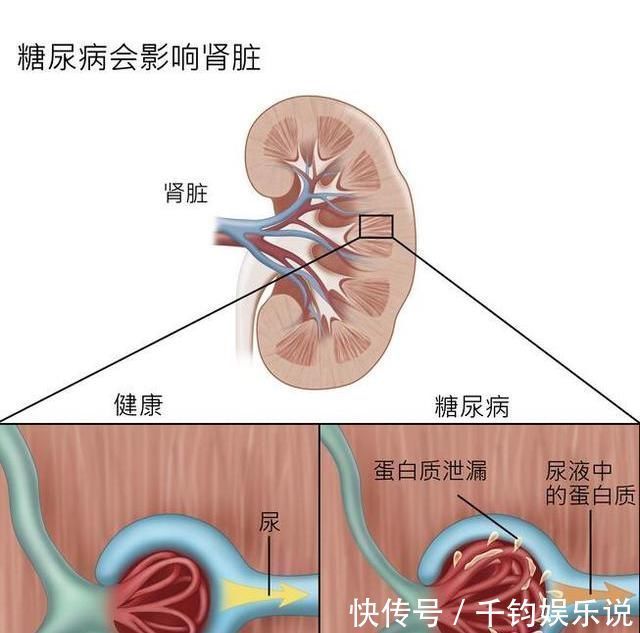 迹象|72岁糖尿病老人，突发“糖肾”衰竭，医生：3个迹象要小心