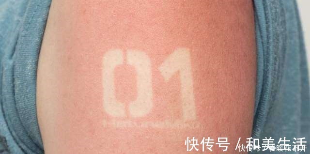 晒伤|日本宅男COS初音被严重晒伤,去年的教训只记得一半的下场