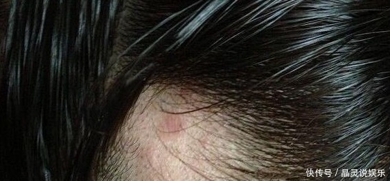 油脂|头皮上长出“小疙瘩”,可能是有大问题,为了家里人健康了解下!
