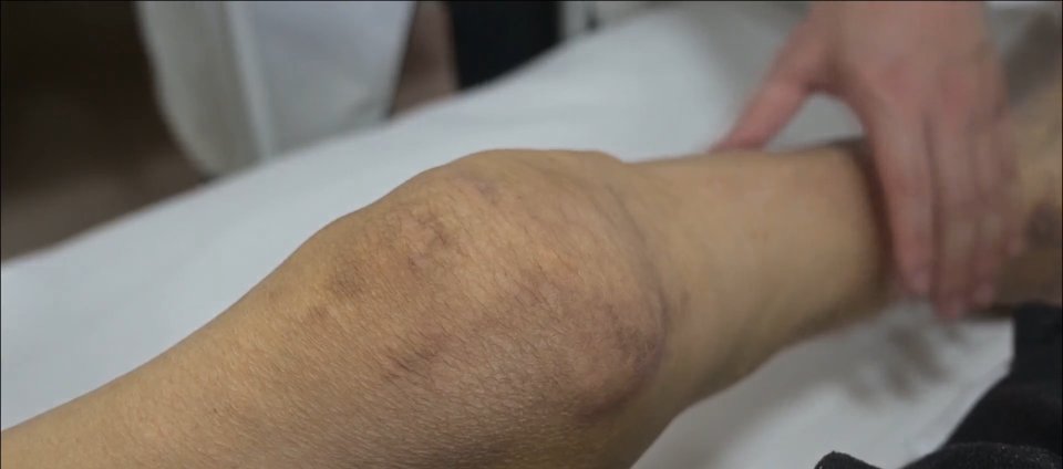 关节|被“石头”啃掉膝关节，男子几乎无法直立行走