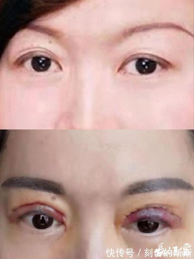 艺龄 双眼皮整成大小眼,艺龄医院手术医生已离职,资料已被老鼠咬坏