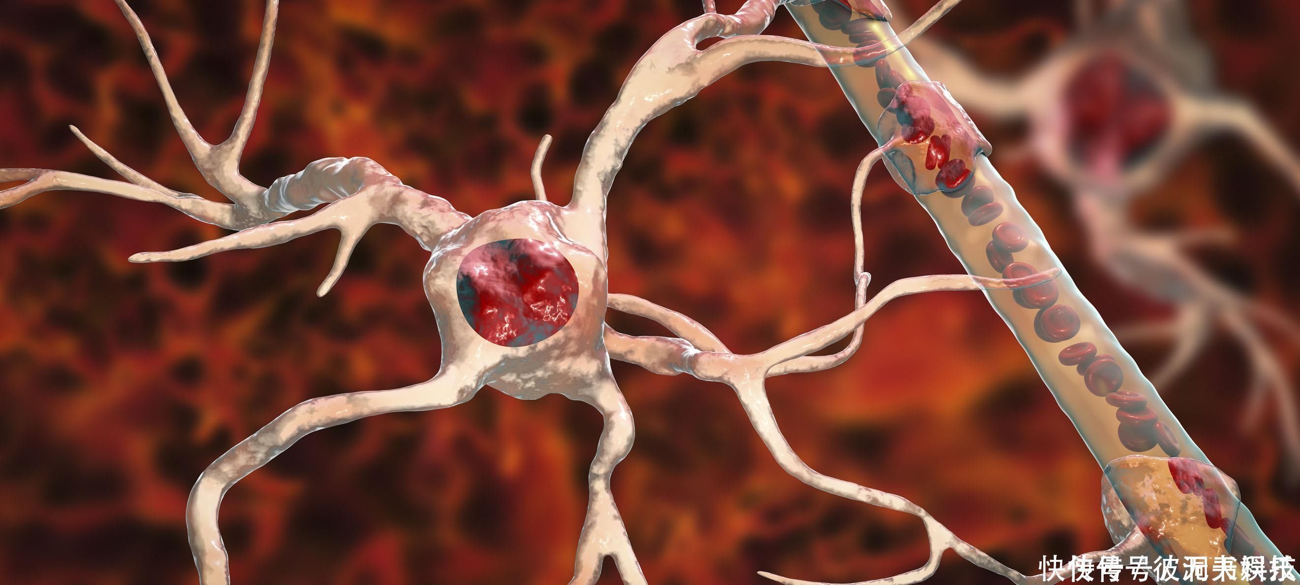 心脑血管|血管堵塞的人,身体3处会“疼痛”,坚持“五个一”,血液更畅通