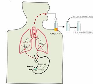胃黏膜|如何知道自己感染了幽门螺杆菌？