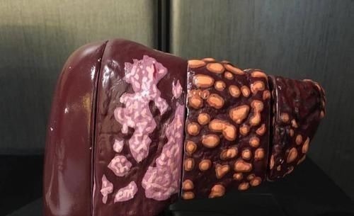 酒精|肝癌是酒“泡”出来的？两个部位很臭，最好去检查一下肝脏CT