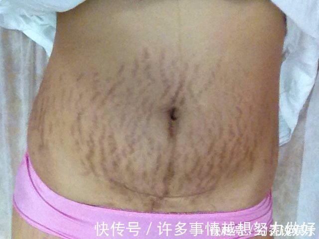 皮肤|女明星生孩子为什么没有妊娠纹,做好这6点你也可以拒绝西瓜肚
