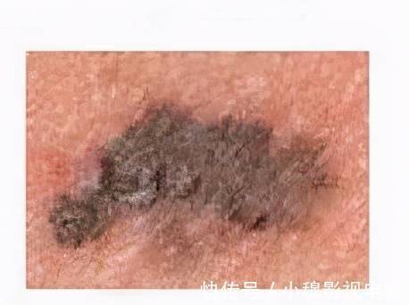 肝癌|身上出现4个小变化,当心肝癌、乳腺癌盯上你!洗澡时看一眼、摸一下能救命