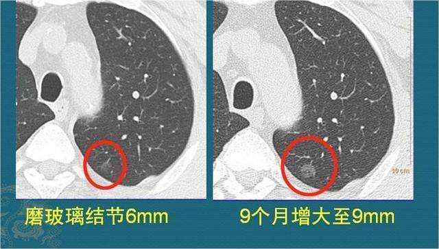 黄勇|肺腺癌是怎么长出来的医生介绍3类肺结节，像种子发芽