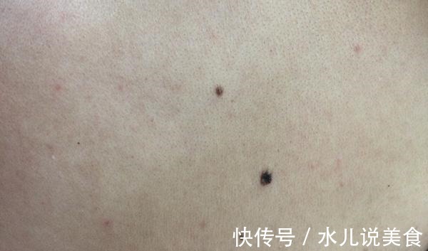表皮|体内有癌,皮肤会打“小报告”,若没有4个异常,或可安心