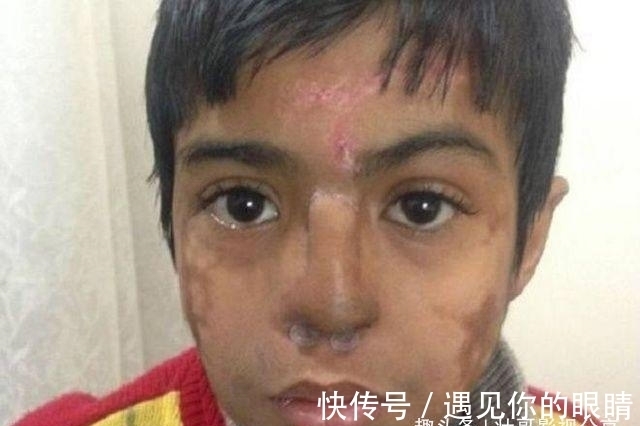 额头|国外小男孩鼻子长在额头上,看了他的经历,真是坚强的表率