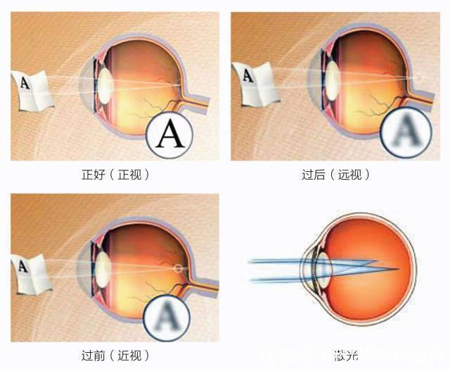 高度近视|不近视的预防近视,已经近视的控制近视度数加深,避免成高度近视
