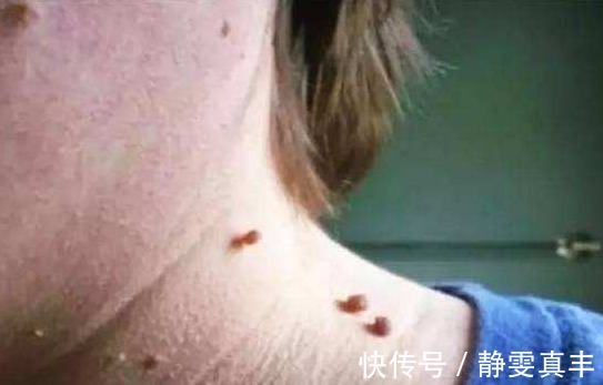肉疙瘩|身上为什么会长出小肉疙瘩身体在向你表达什么呢