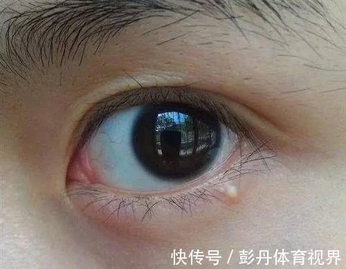长脂肪粒|长了脂肪粒怎么办?不能用手抠也不能抓挠,教你真正的去除办法