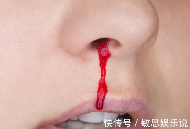 丁香|胃不好鼻先知,若鼻子没有4个异常,恭喜你,说明胃还算健康!