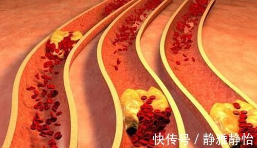 血脂|一旦患有高血脂，再穷也要吃它，清血管垃圾，血脂悄悄降下来